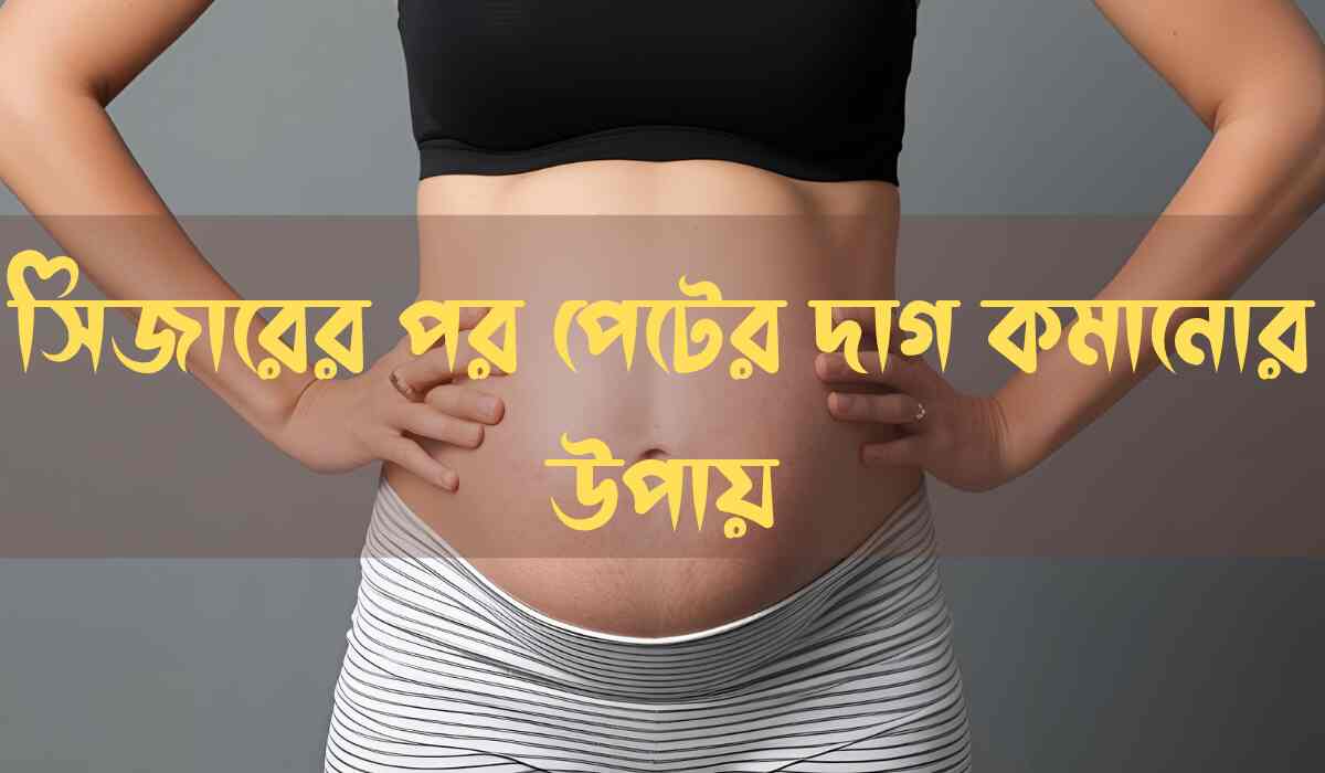 1000206957 সিজারের পর পেটের দাগ কমানোর উপায়