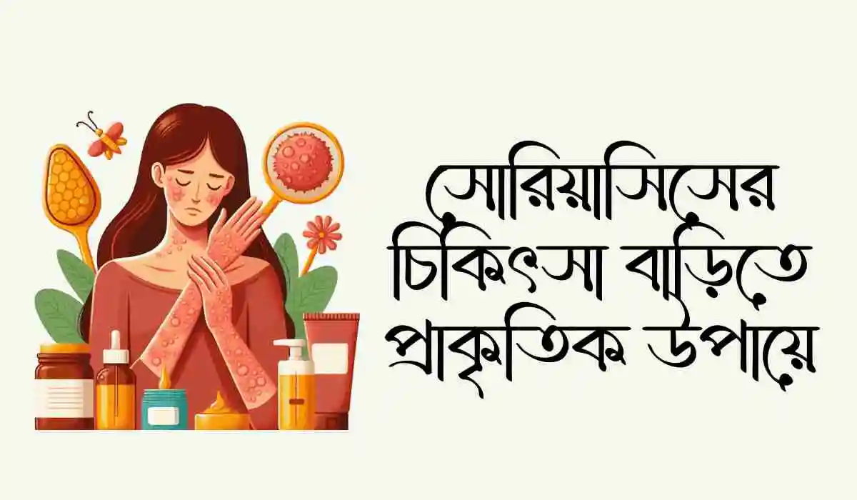 সোরিয়াসিসের চিকিৎসা বাড়িতে প্রাকৃতিক উপায়ে