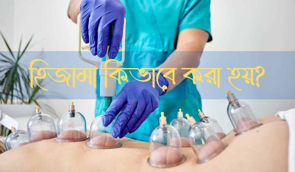 হিজামা কিভাবে করা হয়?